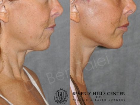 Awake Deep Plane Mini Facelift - Right Side