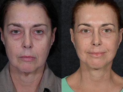 Fractionated CO2 Laser Skin Resurfacing