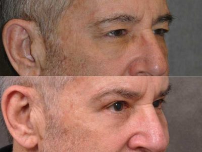 Brow & Eyelid Ptosis Repair with Lower Eyelid Rejuvenation - Right Side