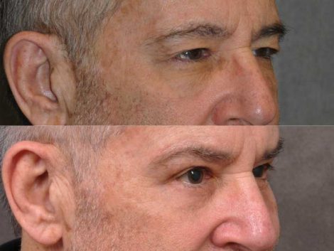 Brow & Eyelid Ptosis Repair with Lower Eyelid Rejuvenation - Right Side