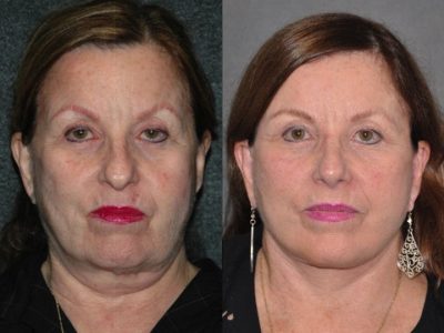 Revision Face and Neck Lift - Front