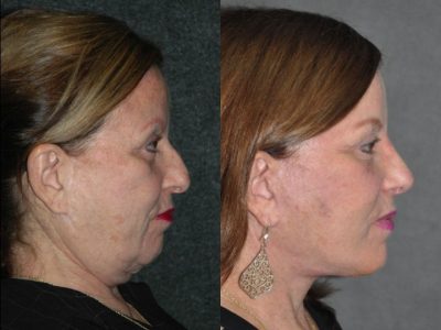 Revision Face and Neck Lift - Right Side