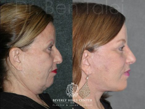 Revision Face and Neck Lift - Right Side