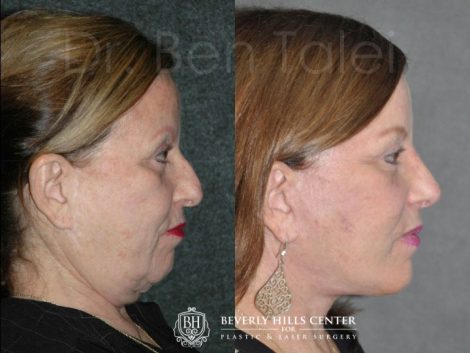 REVISION Face and Neck Lift - Left Side