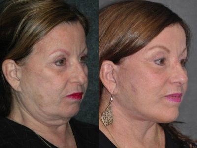 Minimally Invasive (Closed) Rhinoplasty - Right Side