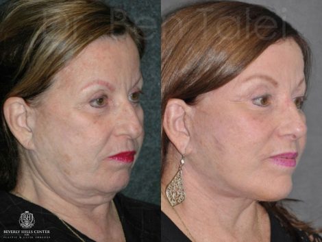 Minimally Invasive (Closed) Rhinoplasty - Right Side