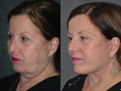 Revision Face and Neck Lift - Left Side