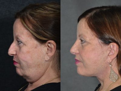Minimally Invasive (Closed) Rhinoplasty - Left Side