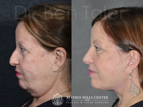 REVISION Face and Neck Lift - Left Side