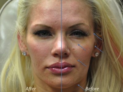Natural Facial Rejuvenation - Front