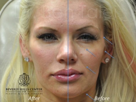 Natural Facial Rejuvenation - Front