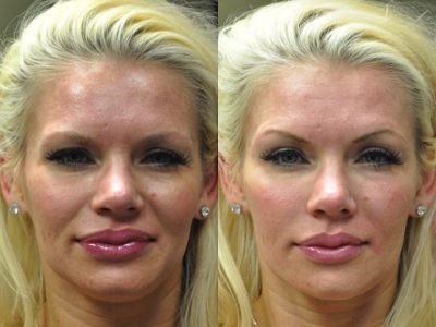 Natural Facial Rejuvenation - Front