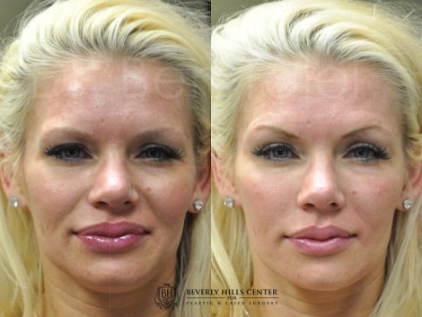 Natural Facial Rejuvenation - Front