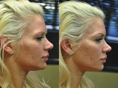 Natural Facial Rejuvenation - Right Side