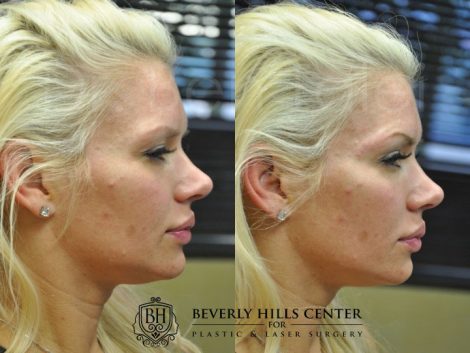 Natural Facial Rejuvenation - Right Side