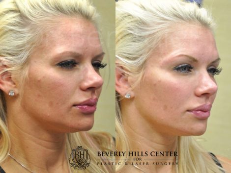 Beverly Hills Center Female Patient Before and After Non-surgical Facial Rejuvenation Procedure