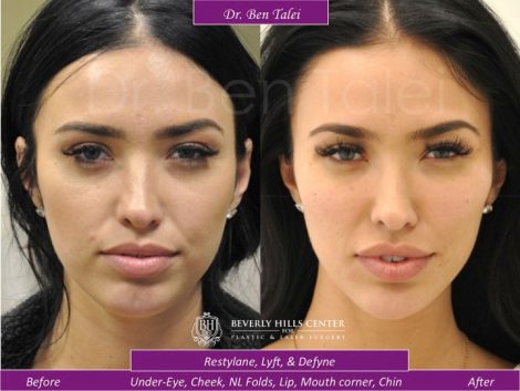 Non-Invasive Facial Contouring Procedures