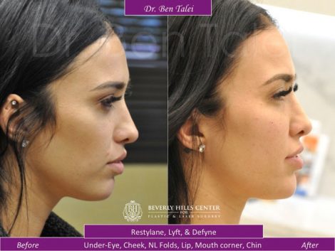Beverly Hills Center Female Patient Before and After Facial Fillers Procedure