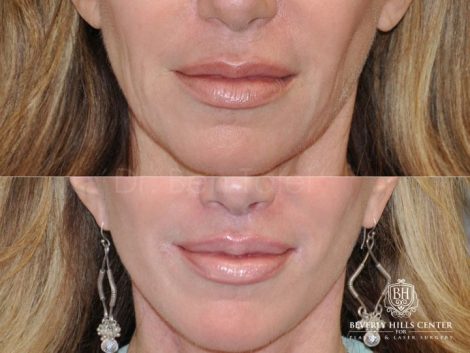 Lip Lift Procedure - Front