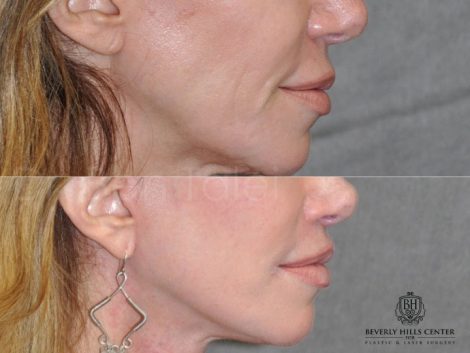 Lip Lift Procedure - Right Side