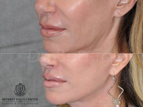 Lip Lift Procedure - Left Side