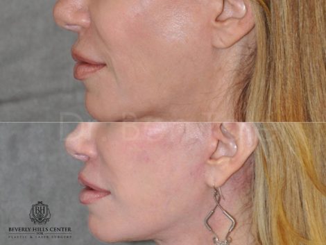 Lip Lift Procedure - Left Side