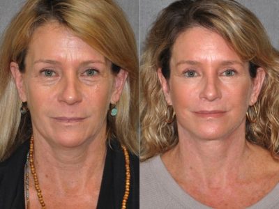 Modified Upper Lip Lift - Front