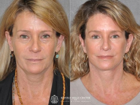 Modified Upper Lip Lift - Front