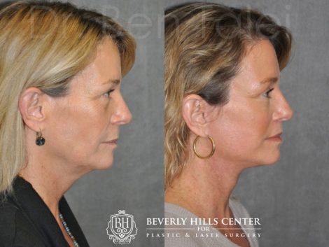 AuraLyft & Lip Lift - Right Side