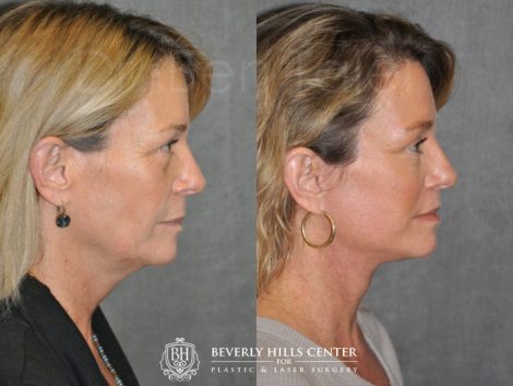 Modified Upper Lip Lift - Right Side