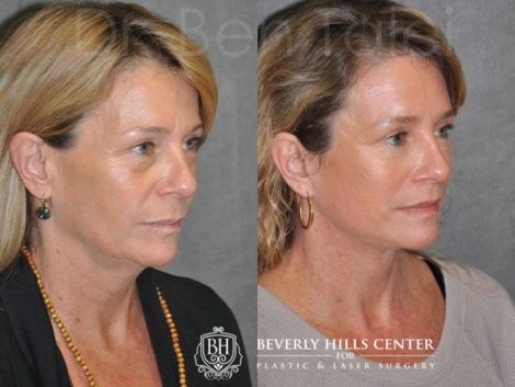 AuraLyft & Lip Lift - Right Side