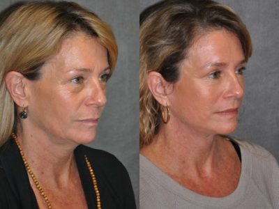 Modified Upper Lip Lift - Right Side