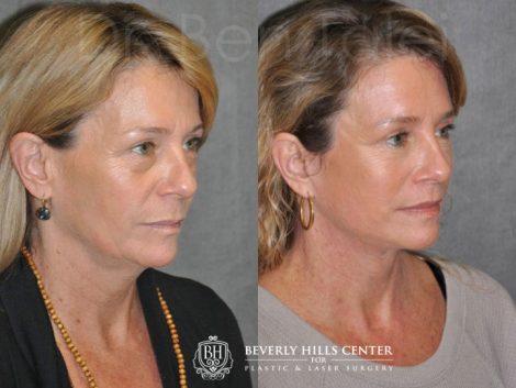 Modified Upper Lip Lift - Right Side