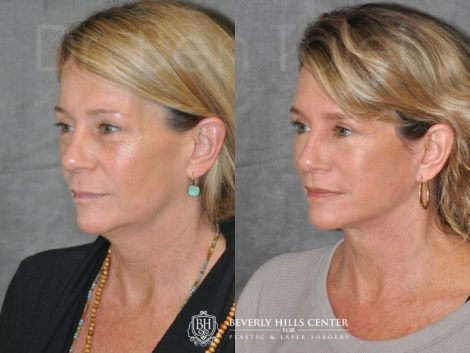 Modified Upper Lip Lift - Left Side