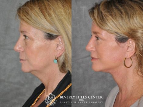 Modified Upper Lip Lift - Left Side