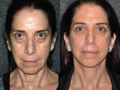 Fractionated CO2 Laser Skin Resurfacing
