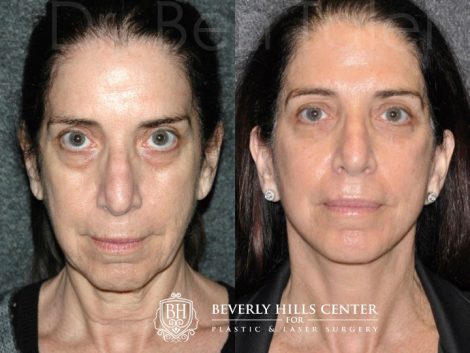 Fractionated CO2 Laser Skin Resurfacing