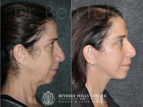 Beverly Hills Center Female Patient Before and After AuraLyft Procedure