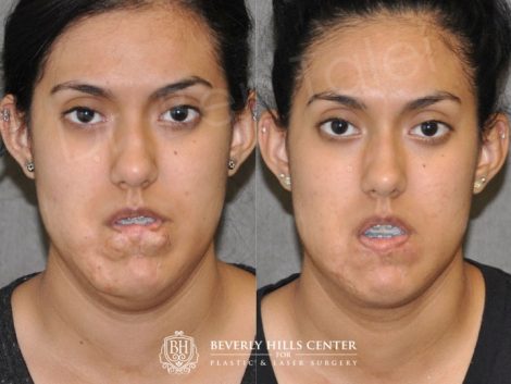 Beverly Hills Center Female Patient Before and After Birthmark and Scar Revision with V-Y Lip Augmenation