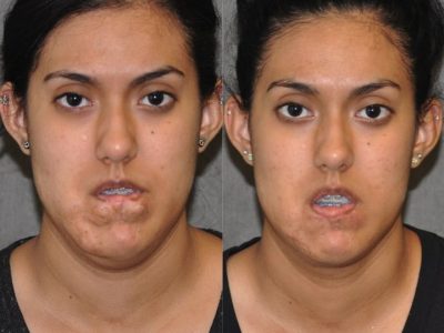 Birthmark and Scar Revision with V-Y Lip Augmenation – Front