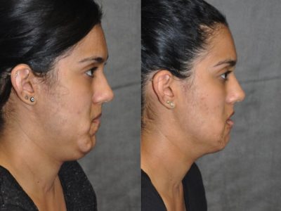 Birthmark and Scar Revision with V-Y Lip Augmenation – Right Side