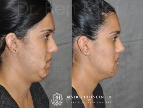Birthmark and Scar Revision with V-Y Lip Augmenation - Right Side