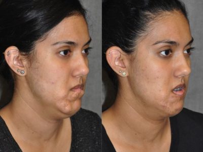 Birthmark and Scar Revision with V-Y Lip Augmenation – Right Side