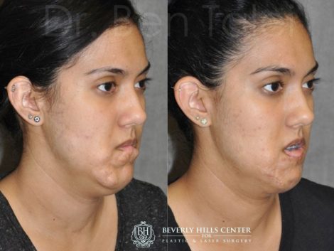 Birthmark and Scar Revision with V-Y Lip Augmenation - Right Side