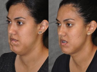 Birthmark and Scar Revision with V-Y Lip Augmenation – Left Side