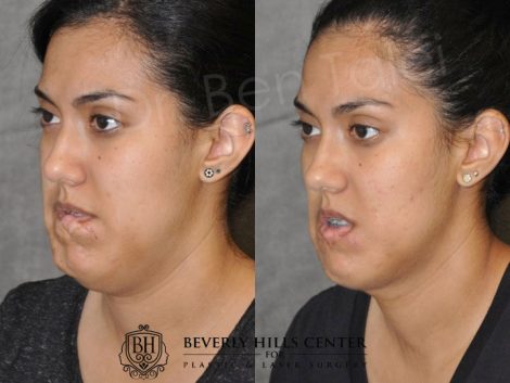 Birthmark and Scar Revision with V-Y Lip Augmenation - Left Side