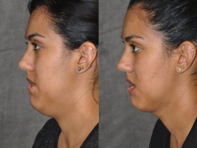 Birthmark and Scar Revision with V-Y Lip Augmenation – Left Side