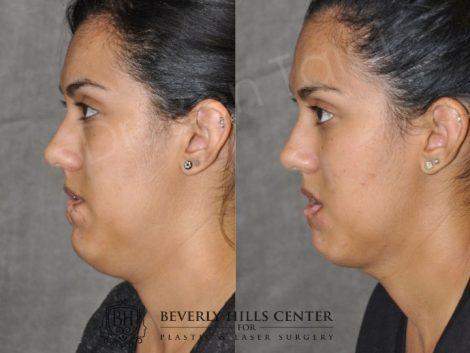Birthmark and Scar Revision with V-Y Lip Augmenation - Left Side
