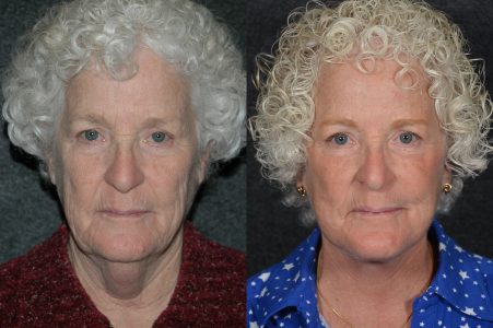 Laser Skin Resurfacing