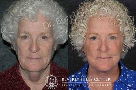 Laser Skin Resurfacing